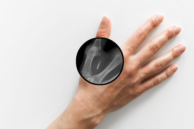 이식된 마이크로칩을 보여주는 부분 x-레이 오버레이가 있는 손.
